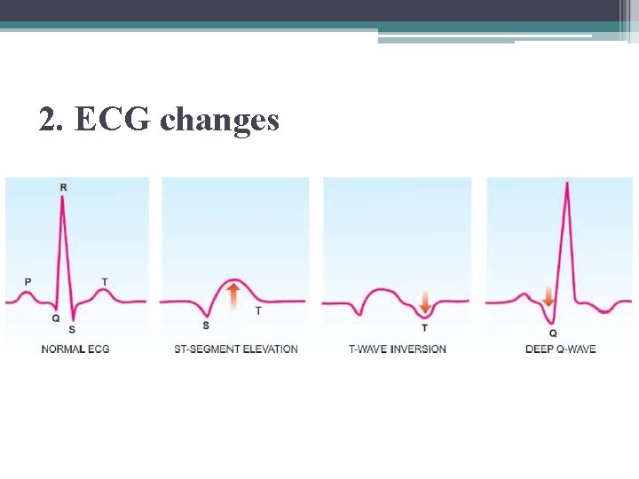 2. ECG changes 