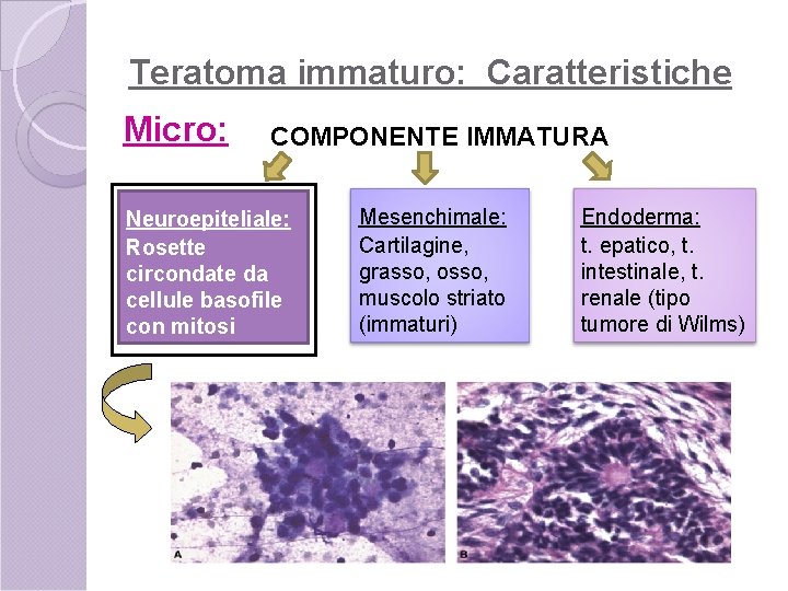 Teratoma immaturo: Caratteristiche Micro: COMPONENTE IMMATURA Neuroepiteliale: Rosette circondate da cellule basofile con mitosi