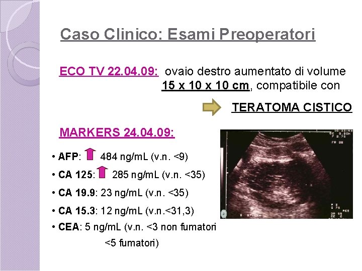 Caso Clinico: Esami Preoperatori ECO TV 22. 04. 09: ovaio destro aumentato di volume