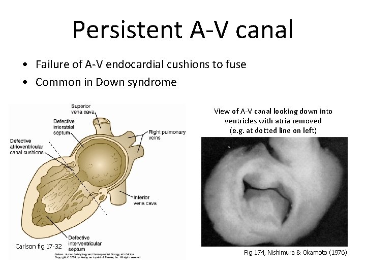 Persistent A-V canal • Failure of A-V endocardial cushions to fuse • Common in