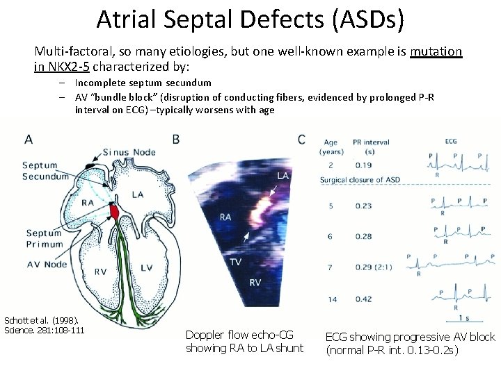 Atrial Septal Defects (ASDs) Multi-factoral, so many etiologies, but one well-known example is mutation