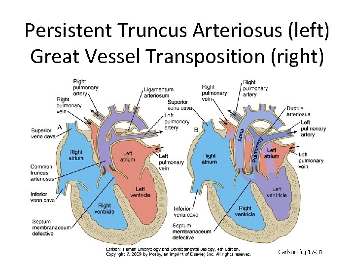 Persistent Truncus Arteriosus (left) Great Vessel Transposition (right) Carlson fig 17 -31 