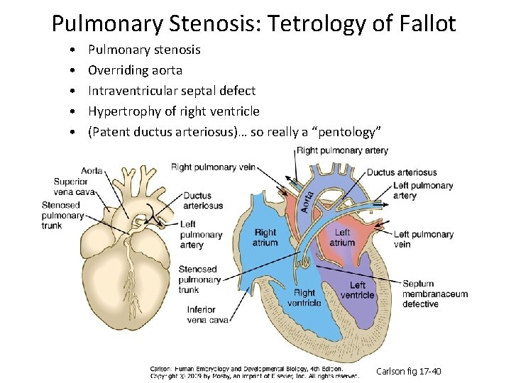 Pulmonary Stenosis: Tetrology of Fallot • • • Pulmonary stenosis Overriding aorta Intraventricular septal