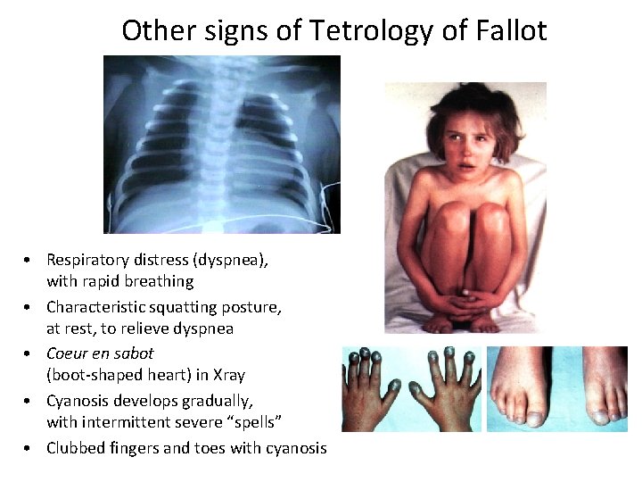 Other signs of Tetrology of Fallot • Respiratory distress (dyspnea), with rapid breathing •