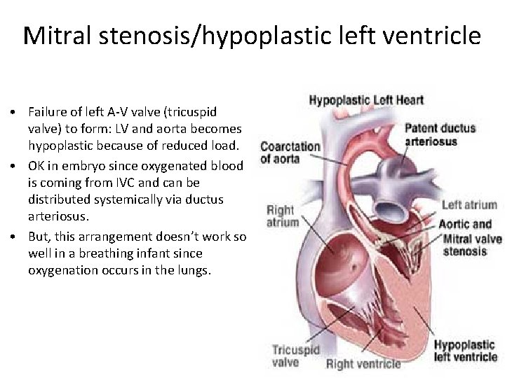 Mitral stenosis/hypoplastic left ventricle • Failure of left A-V valve (tricuspid valve) to form: