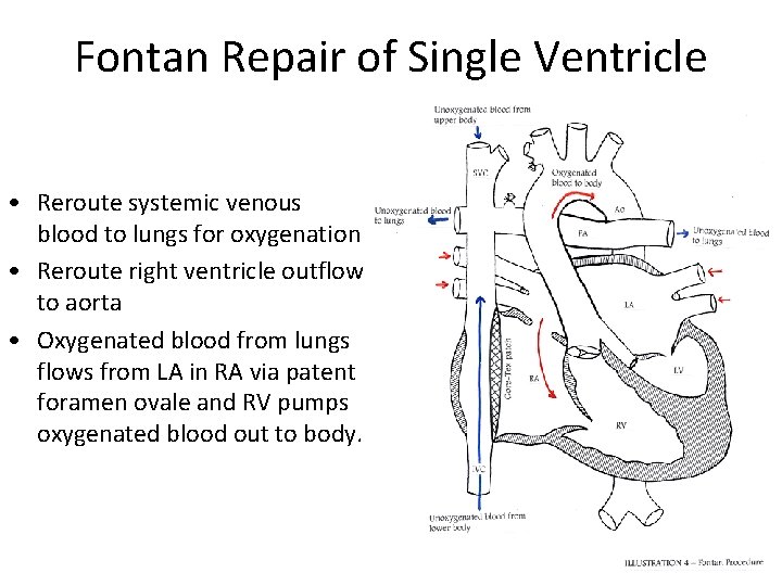 Fontan Repair of Single Ventricle • Reroute systemic venous blood to lungs for oxygenation