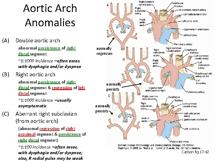 Aortic Arch Anomalies (A) Double aortic arch abnormal persistence of right distal segment ~1: