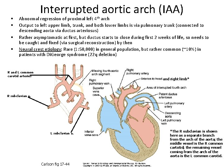  • • Interrupted aortic arch (IAA) Abnormal regression of proximal left 4 th