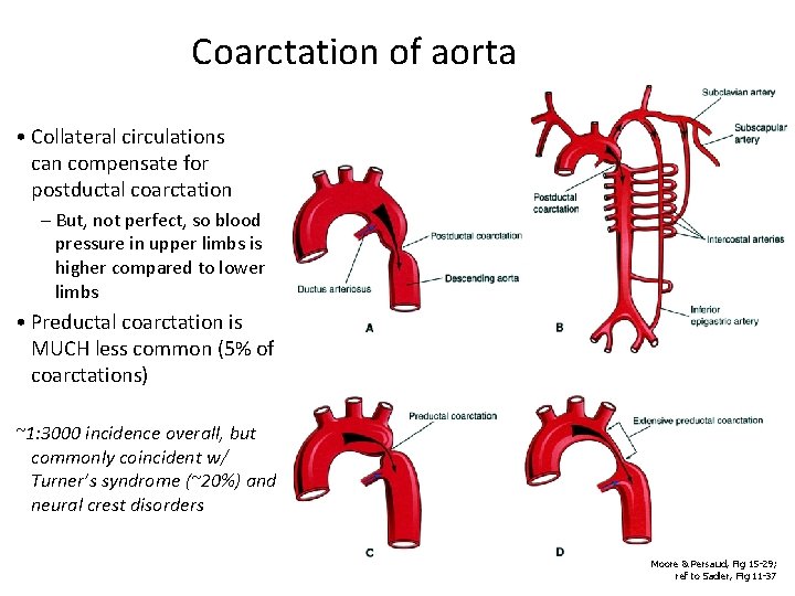 Coarctation of aorta • Collateral circulations can compensate for postductal coarctation – But, not