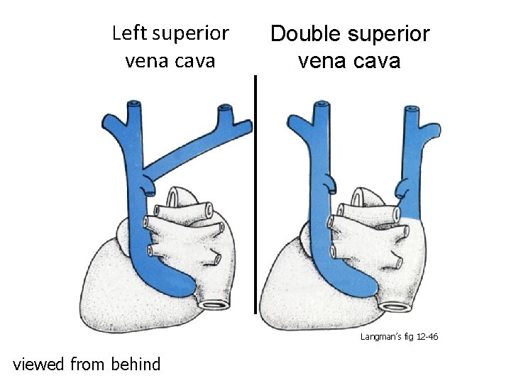 Left superior vena cava Double superior vena cava Langman’s fig 12 -46 viewed from