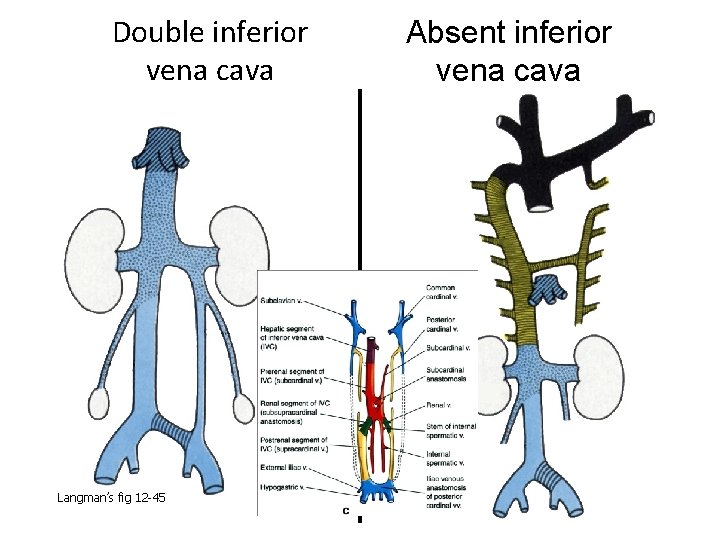 Double inferior vena cava Langman’s fig 12 -45 Absent inferior vena cava 