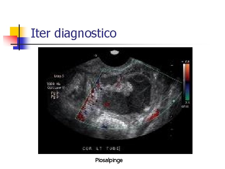 Iter diagnostico Piosalpinge 