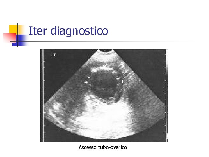Iter diagnostico Ascesso tubo-ovarico 