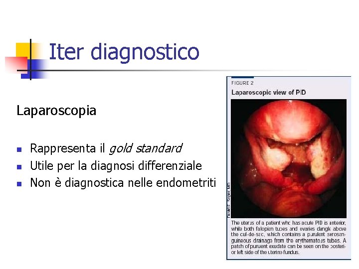 Iter diagnostico Laparoscopia n n n Rappresenta il gold standard Utile per la diagnosi