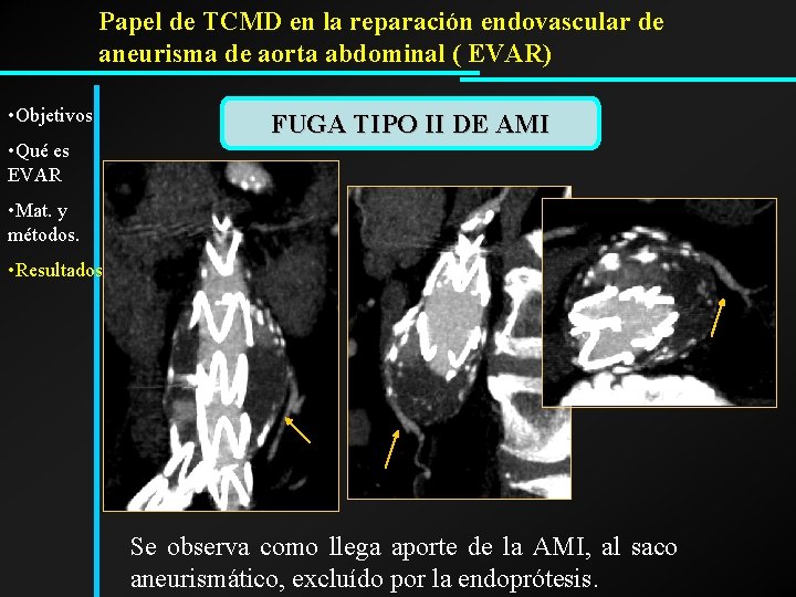 Papel de TCMD en la reparación endovascular de aneurisma de aorta abdominal ( EVAR)