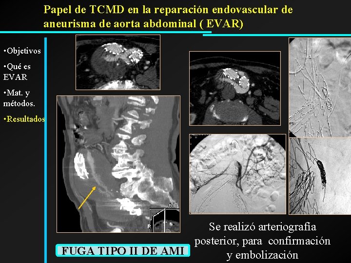 Papel de TCMD en la reparación endovascular de aneurisma de aorta abdominal ( EVAR)