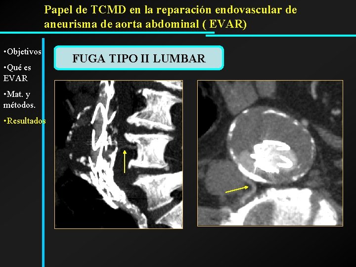 Papel de TCMD en la reparación endovascular de aneurisma de aorta abdominal ( EVAR)