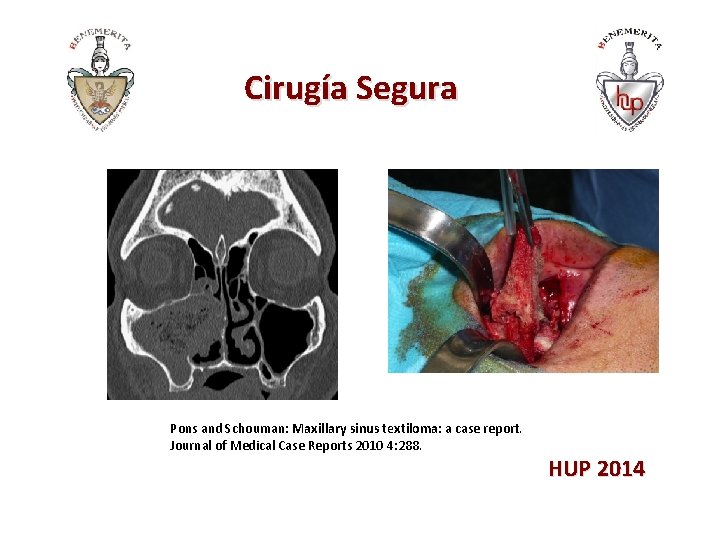 Cirugía Segura Pons and Schouman: Maxillary sinus textiloma: a case report. Journal of Medical