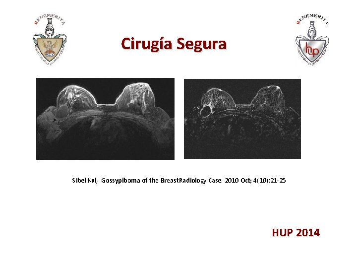 Cirugía Segura Sibel Kul, Gossypiboma of the Breast. Radiology Case. 2010 Oct; 4(10): 21