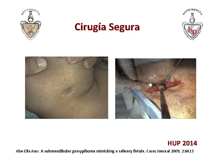 Cirugía Segura HUP 2014 Abu-Ella Amr. A submandibular gossypiboma mimicking a salivary fistula. Cases