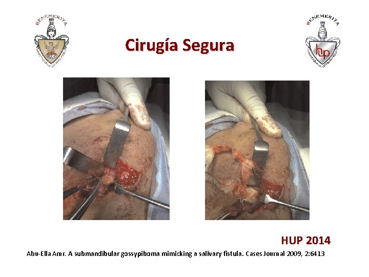 Cirugía Segura HUP 2014 Abu-Ella Amr. A submandibular gossypiboma mimicking a salivary fistula. Cases