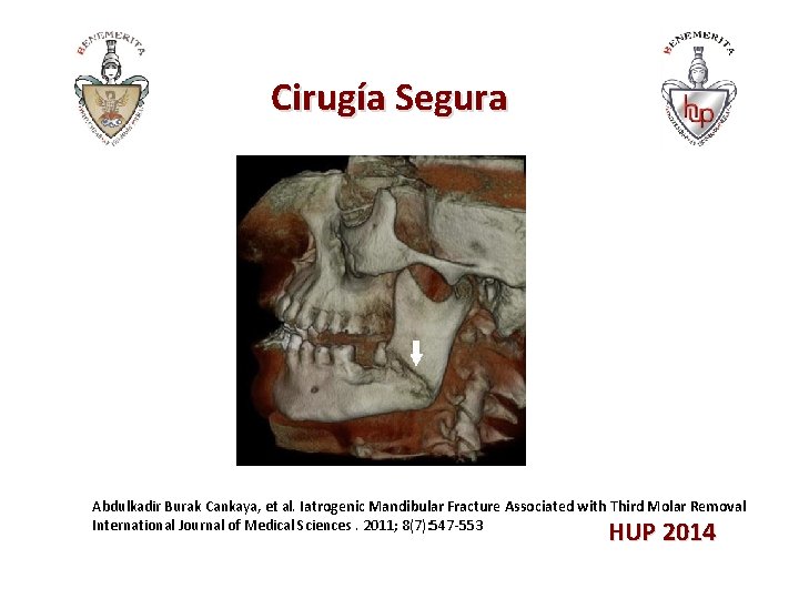 Cirugía Segura Abdulkadir Burak Cankaya, et al. Iatrogenic Mandibular Fracture Associated with Third Molar