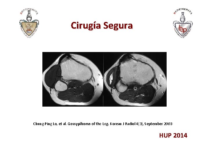 Cirugía Segura Chung-Ping Lo, et al. Gossypiboma of the Leg. Korean J Radiol 4(3),