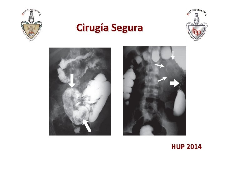 Cirugía Segura HUP 2014 