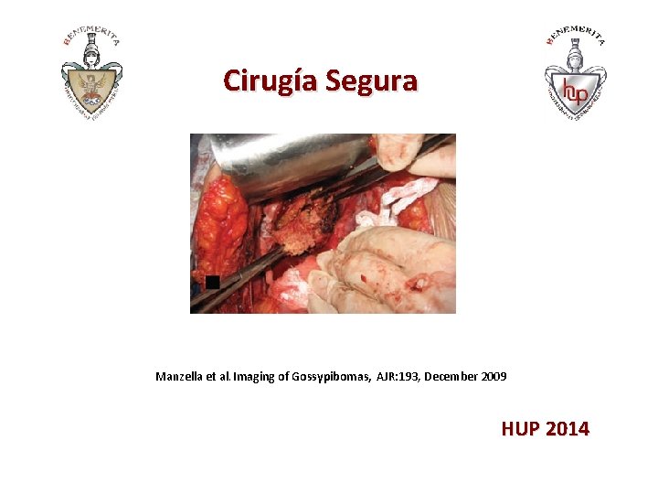 Cirugía Segura Manzella et al. Imaging of Gossypibomas, AJR: 193, December 2009 HUP 2014