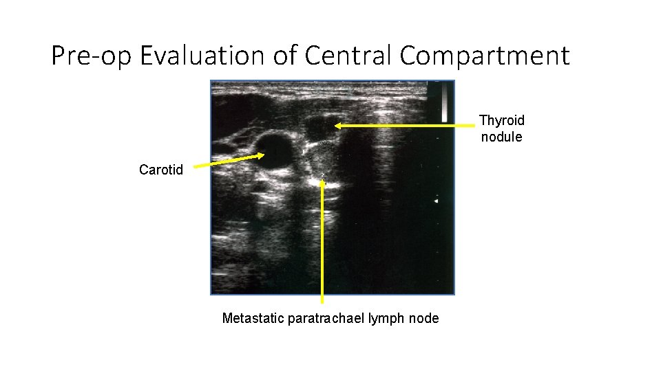 Pre-op Evaluation of Central Compartment Thyroid nodule Carotid Metastatic paratrachael lymph node 
