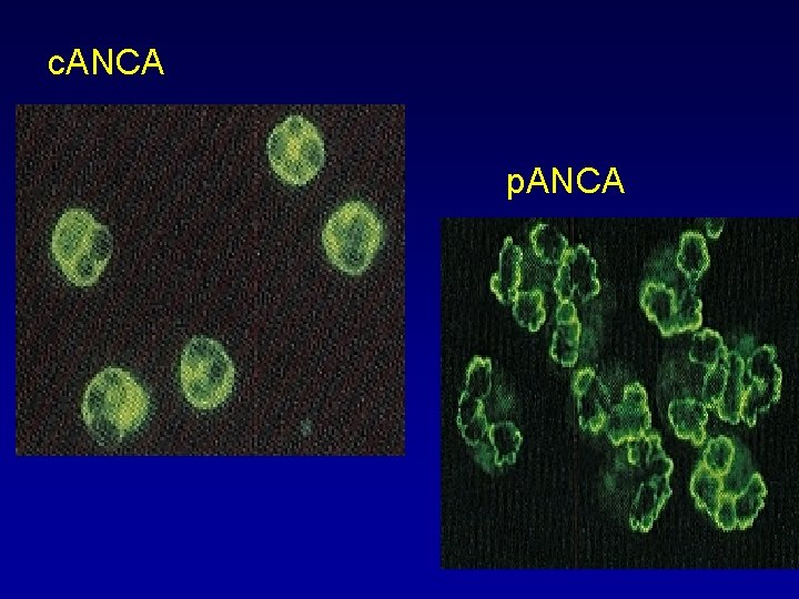 c. ANCA p. ANCA 