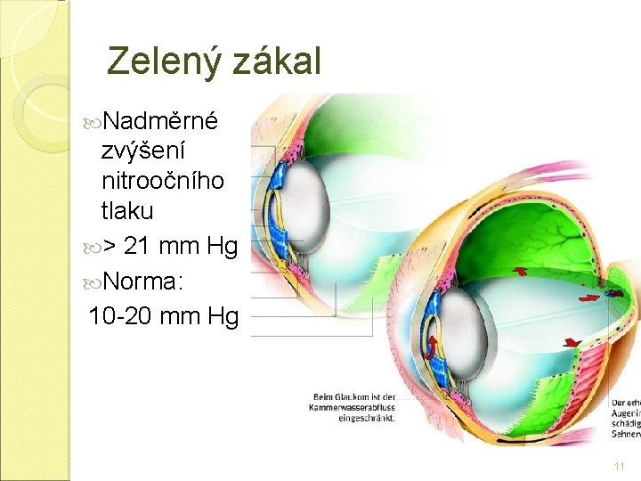 Zelený zákal Nadměrné zvýšení nitroočního tlaku > 21 mm Hg Norma: 10 -20 mm