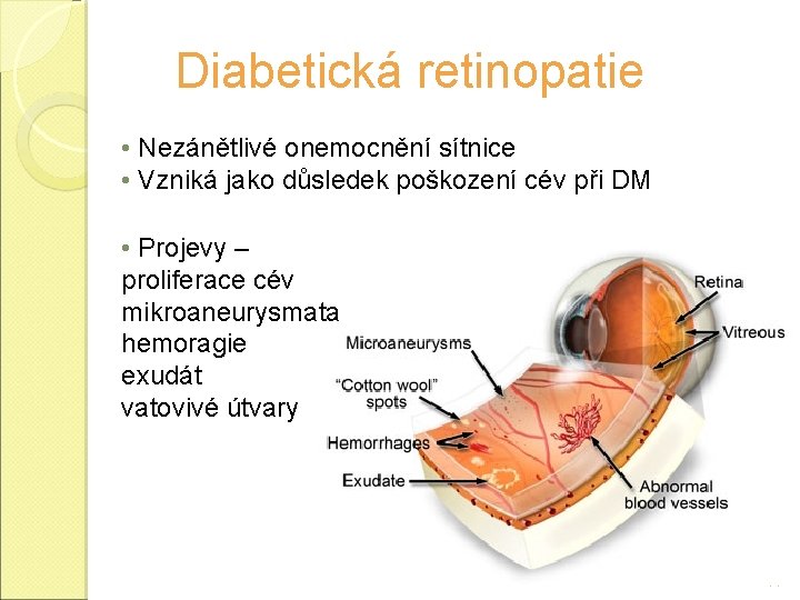 Diabetická retinopatie • Nezánětlivé onemocnění sítnice • Vzniká jako důsledek poškození cév při DM