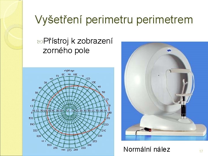 Vyšetření perimetru perimetrem Přístroj k zobrazení zorného pole Normální nález 17 