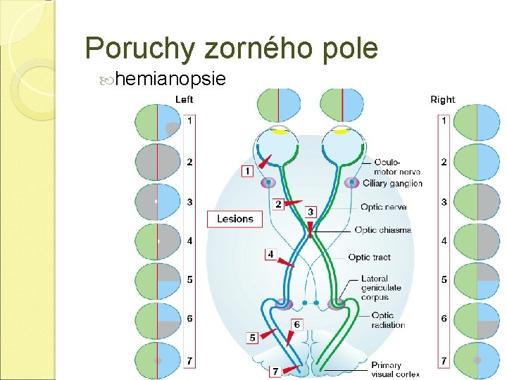 Poruchy zorného pole hemianopsie 18 