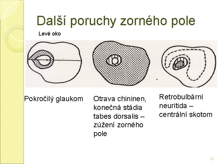 Další poruchy zorného pole Levé oko Pokročilý glaukom Otrava chininen, konečná stádia tabes dorsalis