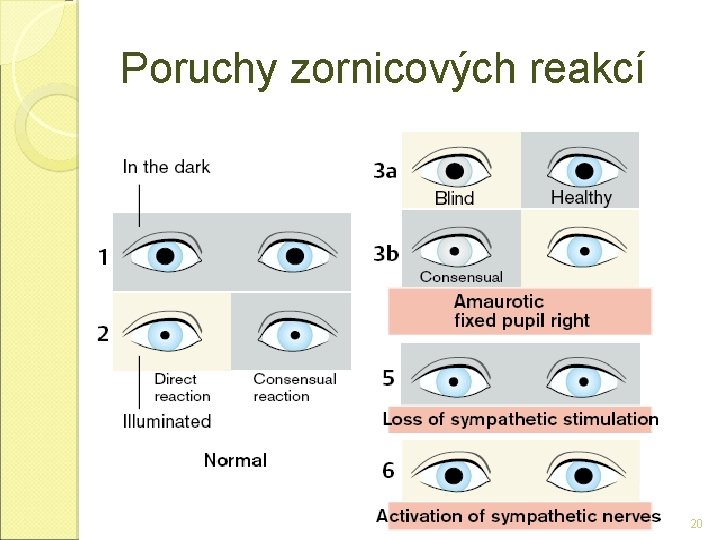 Poruchy zornicových reakcí 20 