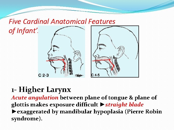 Five Cardinal Anatomical Features of Infant’s Larynx 1 - Higher Larynx Acute angulation between