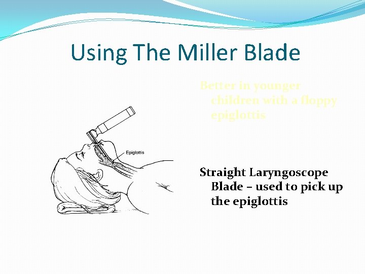 Using The Miller Blade Better in younger children with a floppy epiglottis Straight Laryngoscope