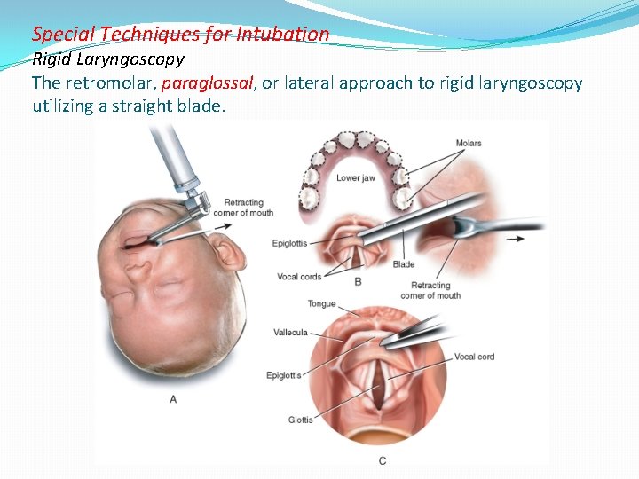 Special Techniques for Intubation Rigid Laryngoscopy The retromolar, paraglossal, or lateral approach to rigid