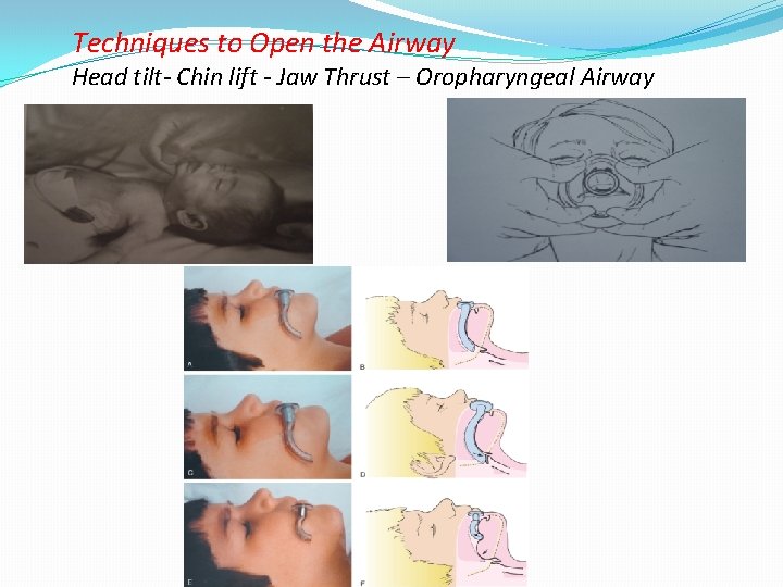 Techniques to Open the Airway Head tilt- Chin lift - Jaw Thrust – Oropharyngeal