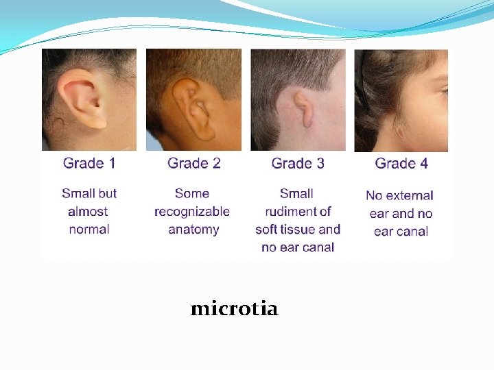 microtia 