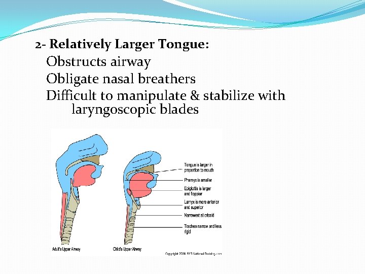 2 - Relatively Larger Tongue: Obstructs airway Obligate nasal breathers Difficult to manipulate &