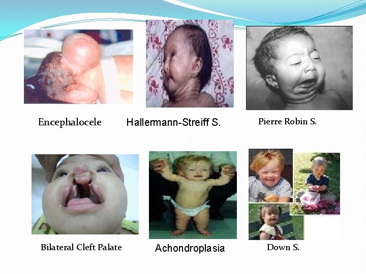 Encephalocele Bilateral Cleft Palate Hallermann-Streiff S. Achondroplasia Pierre Robin S. Down S. 
