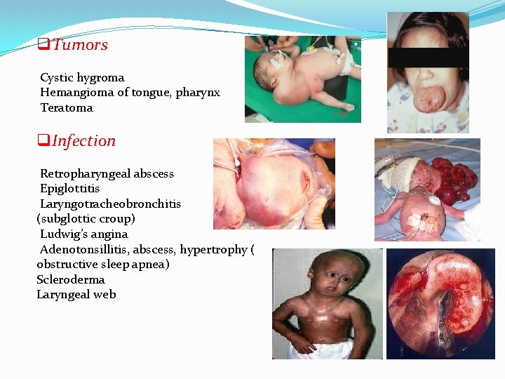 q. Tumors Cystic hygroma Hemangioma of tongue, pharynx Teratoma q. Infection Retropharyngeal abscess Epiglottitis