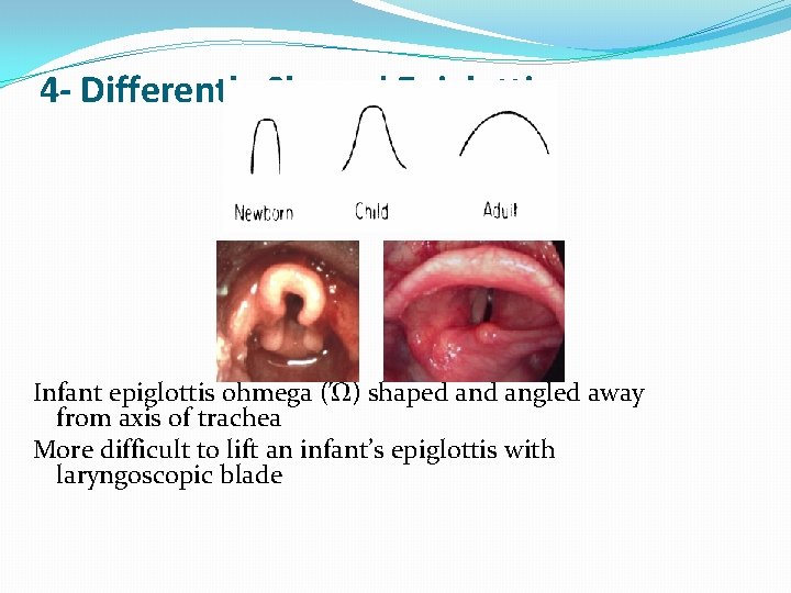 4 - Differently Shaped Epiglottis Infant epiglottis ohmega (Ώ) shaped angled away from axis