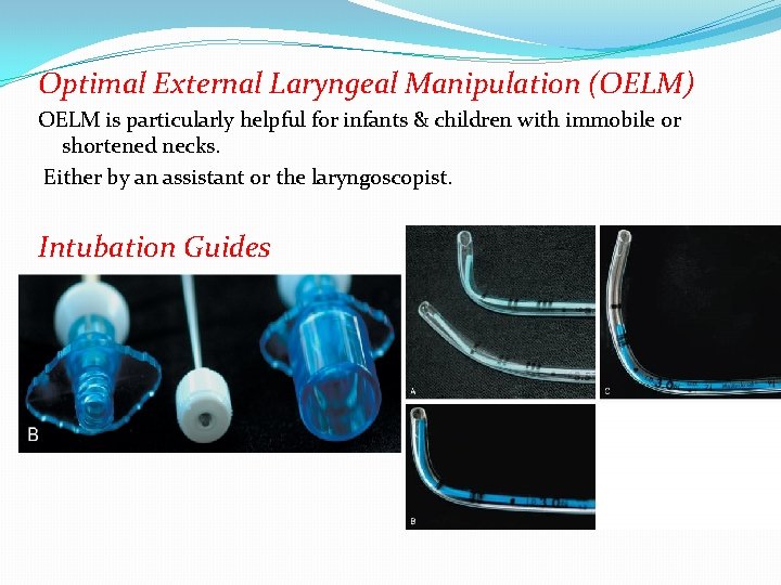 Optimal External Laryngeal Manipulation (OELM) OELM is particularly helpful for infants & children with