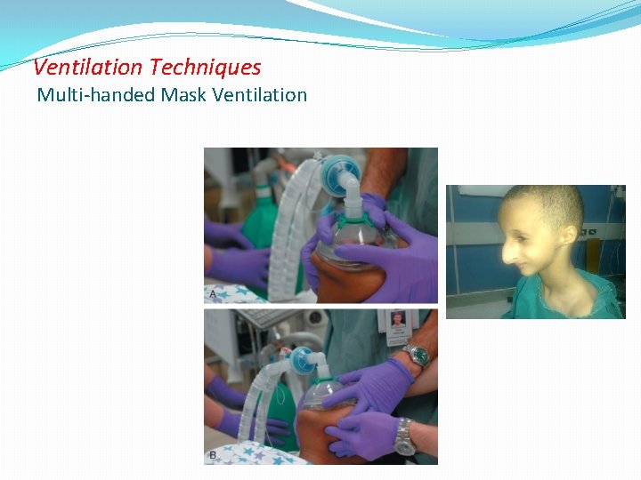 Ventilation Techniques Multi-handed Mask Ventilation 