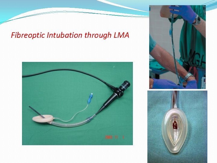 Fibreoptic Intubation through LMA 