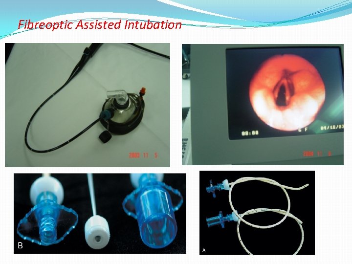 Fibreoptic Assisted Intubation 